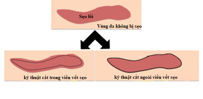 vị trí cắt sẹo 1
