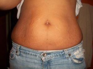 Còn cách nào khác để cải thiện da lỏng lẻo và rạn da ngoài phẫu thuật không?