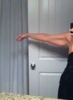 Nên căng da cánh tay hay hút mỡ? Nên căng da cánh tay hay hút mỡ?