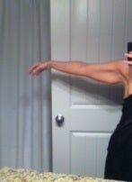 Nên căng da cánh tay hay hút mỡ?