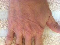 Chất làm đầy tốt nhất cho da bàn tay mỏng, nhăn nheo?