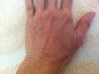 Chất làm đầy tốt nhất cho da bàn tay mỏng, nhăn nheo?