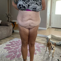 Căng da vùng thân dưới có nâng mông chảy xệ không?