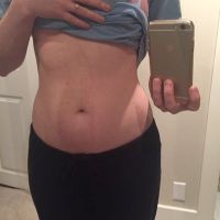 CoolSculpt hay EmSculpt ?