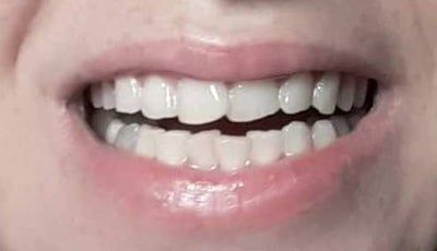 Tôi có cần niềng răng cho cả 2 hàm không? Có đúng là không thể chỉnh sửa răng cửa hàm trên của tôi bằng cách dán sứ Veneers hoặc Lumineers không?