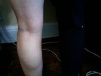 Căng da vùng thân dưới hay căng da đùi để trị rạn da ở bắp chân, hông và đùi?