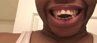 Niềng răng chỉnh sửa khớp cắn và có thể giúp tôi không phải phẫu thuật hàm không?