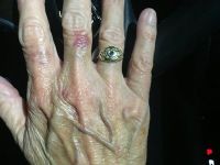 Nên tiêm filler hay mỡ tự thân vào mu bàn tay?