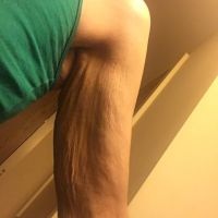 Nên căng da cánh tay toàn phần hay căng da cánh tay mini? Nên căng da cánh tay toàn phần hay căng da cánh tay mini?