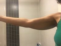 Nên căng da cánh tay toàn phần hay căng da cánh tay mini? Nên căng da cánh tay toàn phần hay căng da cánh tay mini?