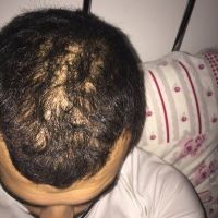 Có thể dùng Finasteride và Minoxidil cùng một lúc không?