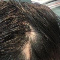 Đây có phải là rụng tóc từng vùng không?