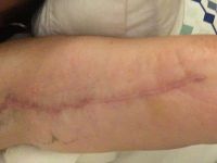 Đây có phải là sẹo phì đại không? Đây có phải là sẹo phì đại không?