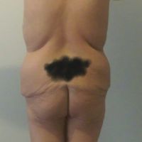 Sau giảm 30kg thì cần phẫu thuật những chỗ nào?