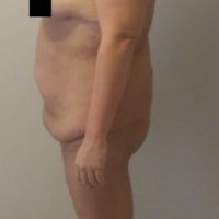 Sau giảm 30kg thì cần phẫu thuật những chỗ nào?