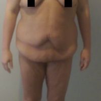 Sau giảm 30kg thì cần phẫu thuật những chỗ nào?