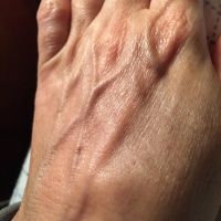 Điều trị tĩnh mạch nổi trên mu bàn tay?