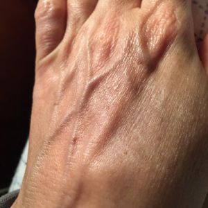 Điều trị tĩnh mạch nổi trên mu bàn tay?