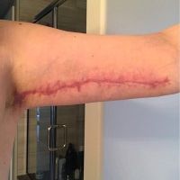 Vết sẹo bị đỏ và rộng sau căng da cánh tay Vết sẹo bị đỏ và rộng sau căng da cánh tay