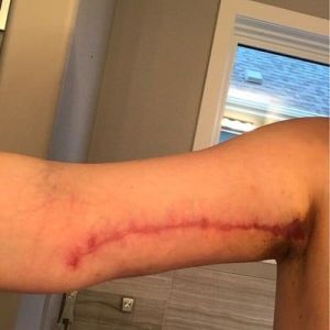 Vết sẹo bị đỏ và rộng sau căng da cánh tay