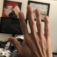 Có thể sử dụng chất làm đầy vào ngón tay không?