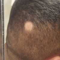 Mất một mảng tóc nhỏ trên đầu là do nguyên nhân nào?