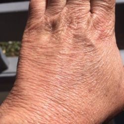 Loại laser hiệu quả nhất để căng da bàn tay?
