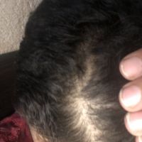 Rụng tóc đột ngột là do đâu?