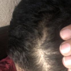 Rụng tóc đột ngột là do đâu?