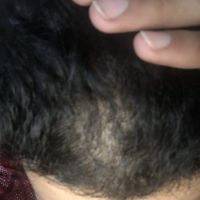 Rụng tóc đột ngột là do đâu?