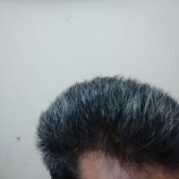 Điều trị rụng tóc trong thời gian dài không thấy cải thiện?
