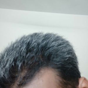 Điều trị rụng tóc trong thời gian dài không thấy cải thiện?
