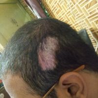 Tóc có mọc lại ở vết thương không?