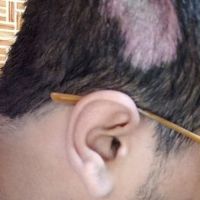 Tóc có mọc lại ở vết thương không?