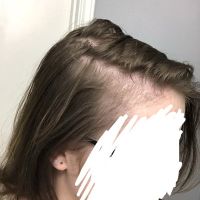 Tôi bị hói hay chỉ là tóc thưa thôi?