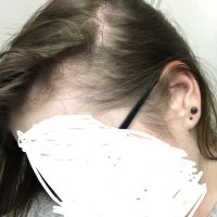 Tôi bị hói hay chỉ là tóc thưa thôi?