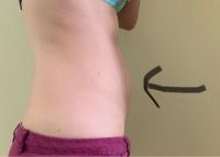 EmSculpt có cải thiện được bụng dưới sau sinh con không?