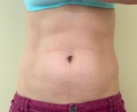 EmSculpt có cải thiện được bụng dưới sau sinh con không?