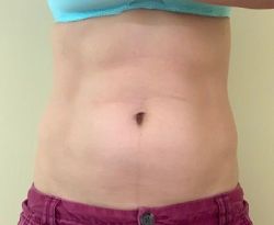 EmSculpt có cải thiện được bụng dưới sau sinh con không?