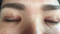 Sẹo phì đại sau phẫu thuật tạo mắt hai mí, liệu nó có phẳng ra không?