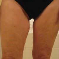 Hút mỡ công nghệ laser SmartLipo có hiệu quả như căng da đùi không?