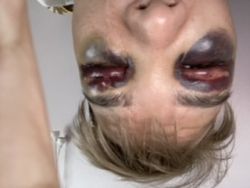 Cắt mí mắt xong bị thâm tím
Và nổi cục có sao không?