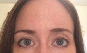 Nên treo lông mày hay cắt mí