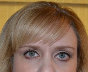 Lật mí dưới sau khi cắt mí dưới bằng phương pháp Skin Pinch