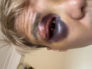 Cắt mí mắt xong bị thâm tím
Và nổi cục có sao không?