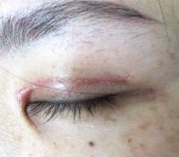 Sẹo phì đại sau phẫu thuật tạo mắt hai mí, liệu nó có phẳng ra không?