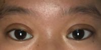 3 tháng sau phẫu thuật: Mí mắt vẫn sưng phồng (nếp mí xúc xích)