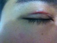 Sẹo lồi sau phẫu thuật cắt mí