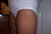 Tôi cần căng da đùi trong qua đường rạch ở vị trí nào?