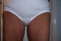 Tôi cần căng da đùi trong qua đường rạch ở vị trí nào?